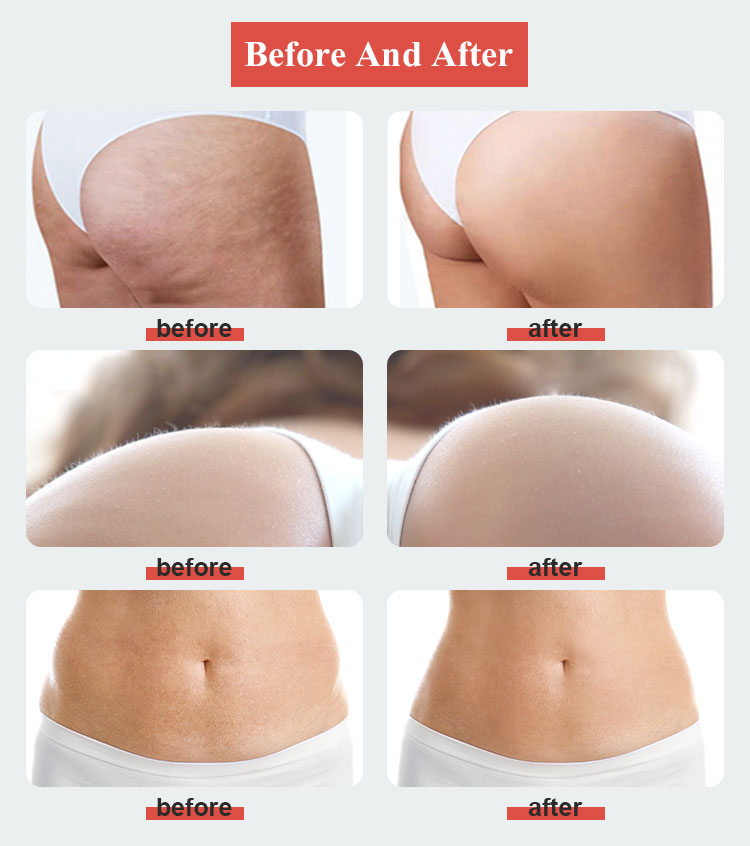 Endosfere Therapy Cellulite Rreatment