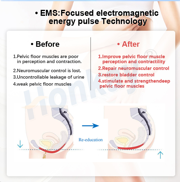 can pelvic floor muscles be repaired