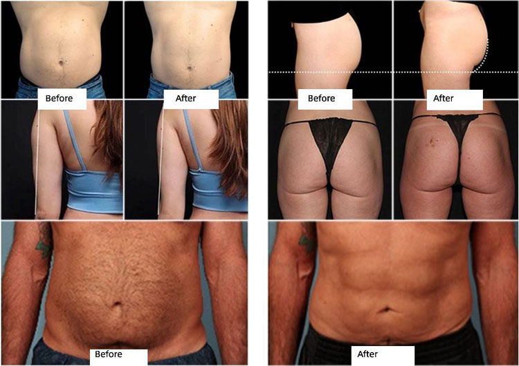 Before and after of ems body sculpt machine